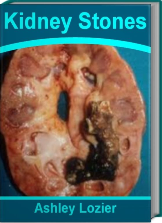 Kidney Stones: Straight Talk About Symptoms of Kidney Stones, What Causes Kidney Stones, Kidney Stones In Women, Passing Kidney Stones