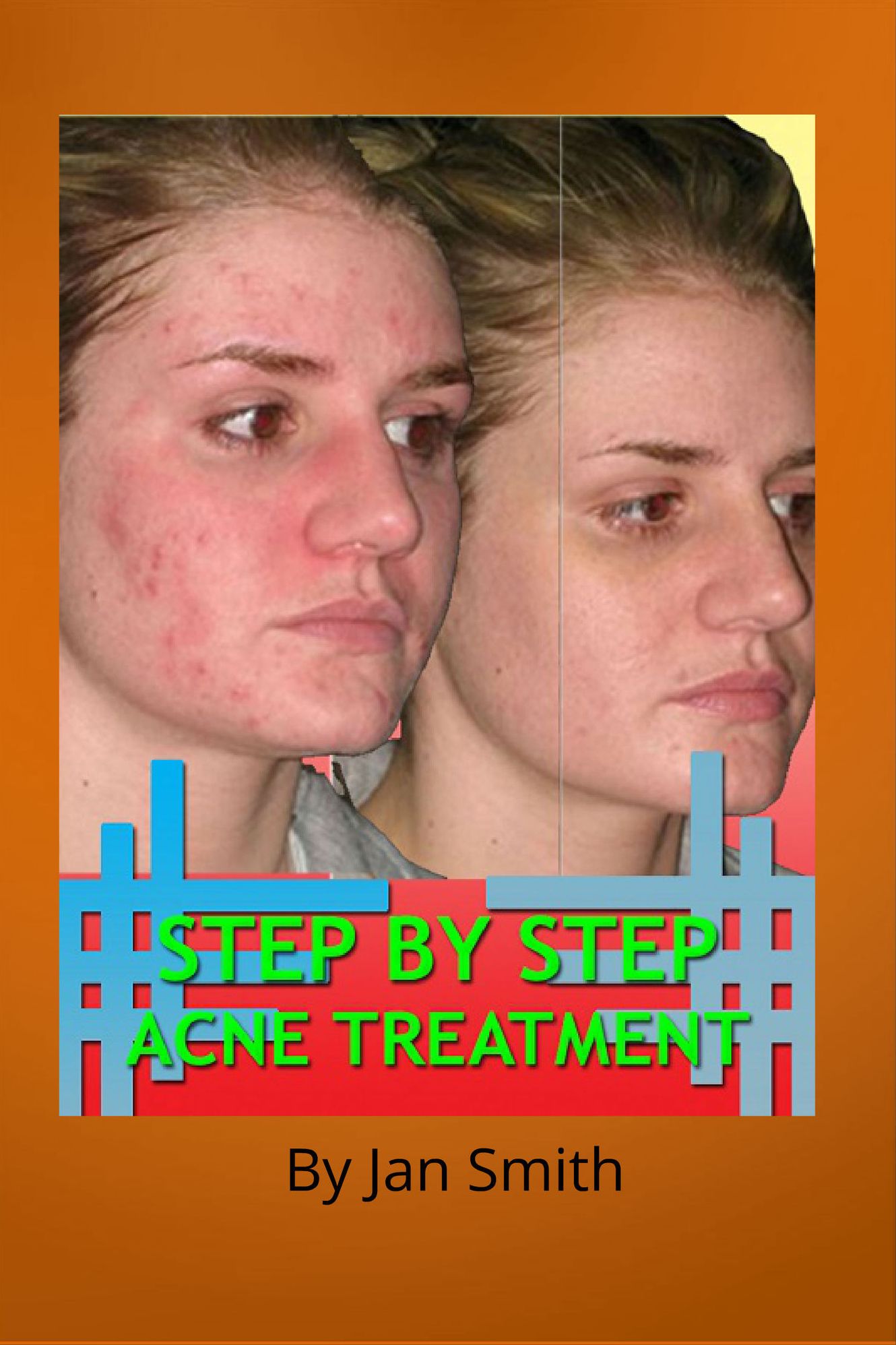 Step By Step Acne Treatment