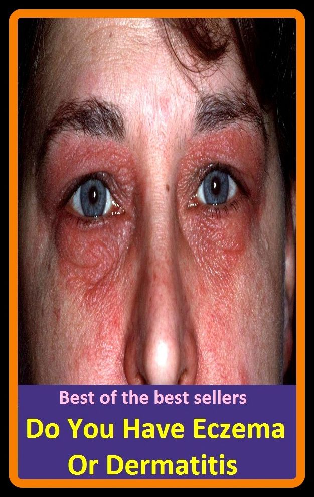 Best of the Best Sellers Do You Have Eczema Or Dermatitis ( cycle, eczema, eczema heretic, eczema hypertrophy, eczema marinate, eczema vaccinate, eczema, , eczema tic, housemates )