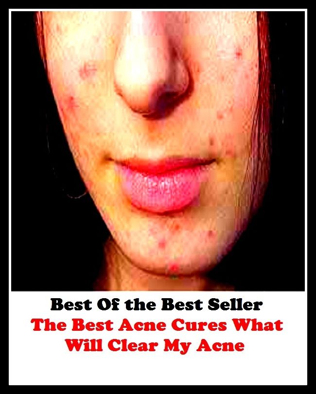 Best of the best sellers The Best Acne Cures What Will Clear My ( exercise, meditation, acupuncture, disease, digestive system, formula, medicine, remedy, fix, treatment, action, conduct, behavior, handling, gastrin, fitness, vitamins )