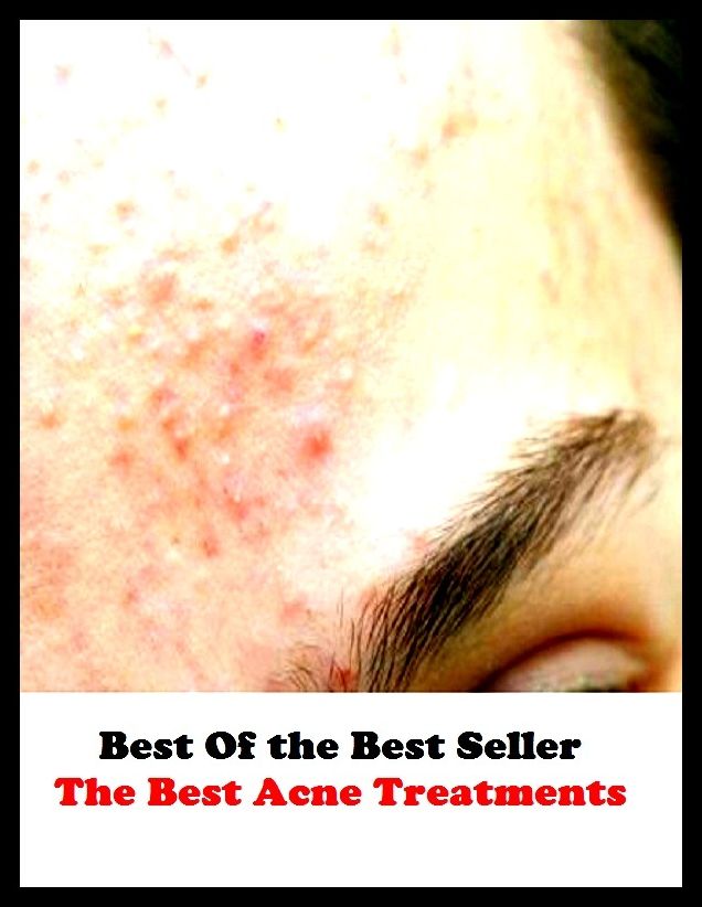 Best of the best sellers The Best Acne Treatments ( exercise, meditation, acupuncture, disease, digestive system, formula, medicine, remedy, fix, treatment, action, conduct, behavior, handling, gastrin, fitness, vitamins, healing, diet )