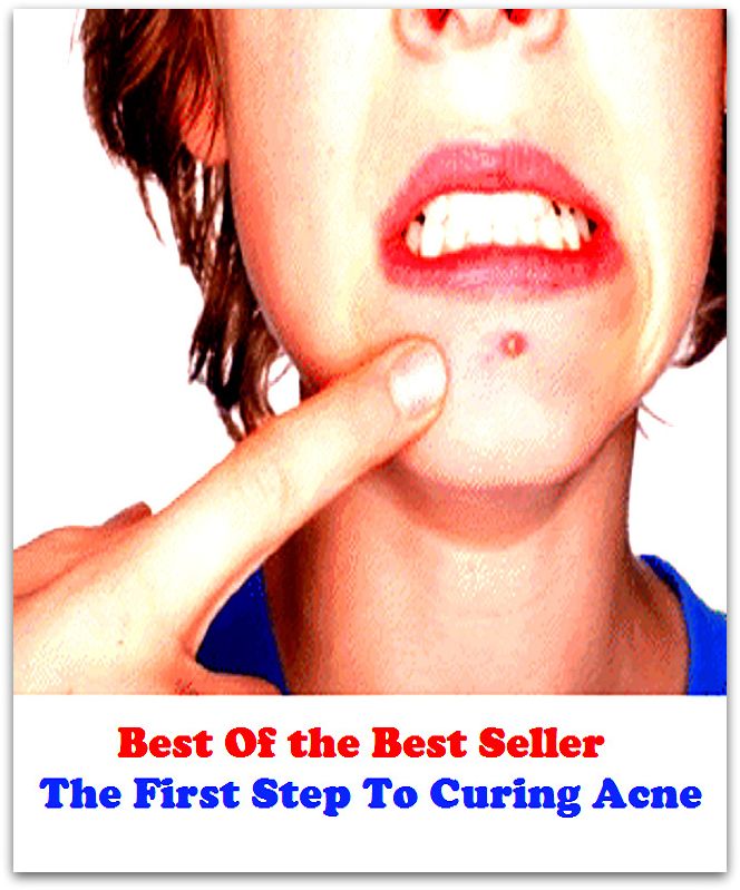 Best of the best sellers The First Step To Curing Acne ( exercise, meditation, acupuncture, disease, digestive system, formula, medicine, remedy, fix, treatment, action, conduct, behavior, handling, gastrin, fitness, vitamins, healing )
