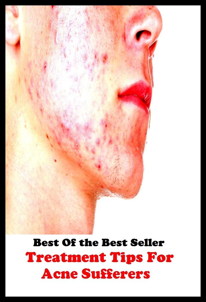 Best of the best sellers Treatment Tips For Acne Sufferers ( exercise, meditation, acupuncture, disease, digestive system, formula, medicine, remedy, fix, treatment, action, conduct, behavior, handling, gastrin, fitness, vitamins )