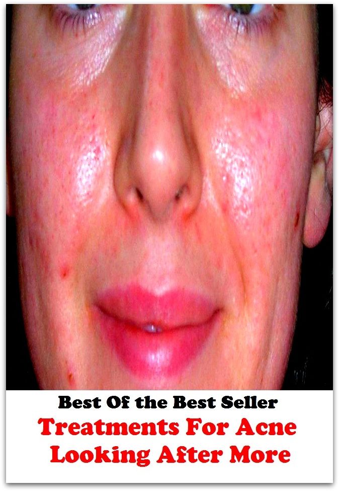 Best of the best sellers Treatments For Acne Looking After More ( exercise, meditation, acupuncture, disease, digestive system, formula, medicine, remedy, fix, treatment, action, conduct, behavior, handling, gastrin, fitness, vitamins )