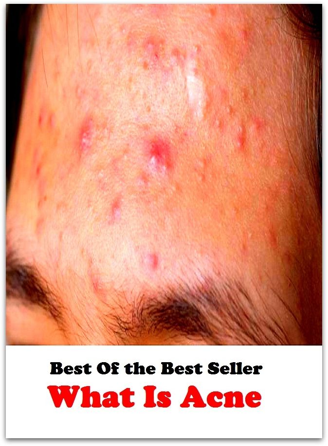 Best of the best sellers What Is Acne ( exercise, meditation, acupuncture, disease, digestive system, formula, medicine, remedy, fix, treatment, action, conduct, behavior, handling, gastrin, fitness, vitamins, healing, diet, cut down )