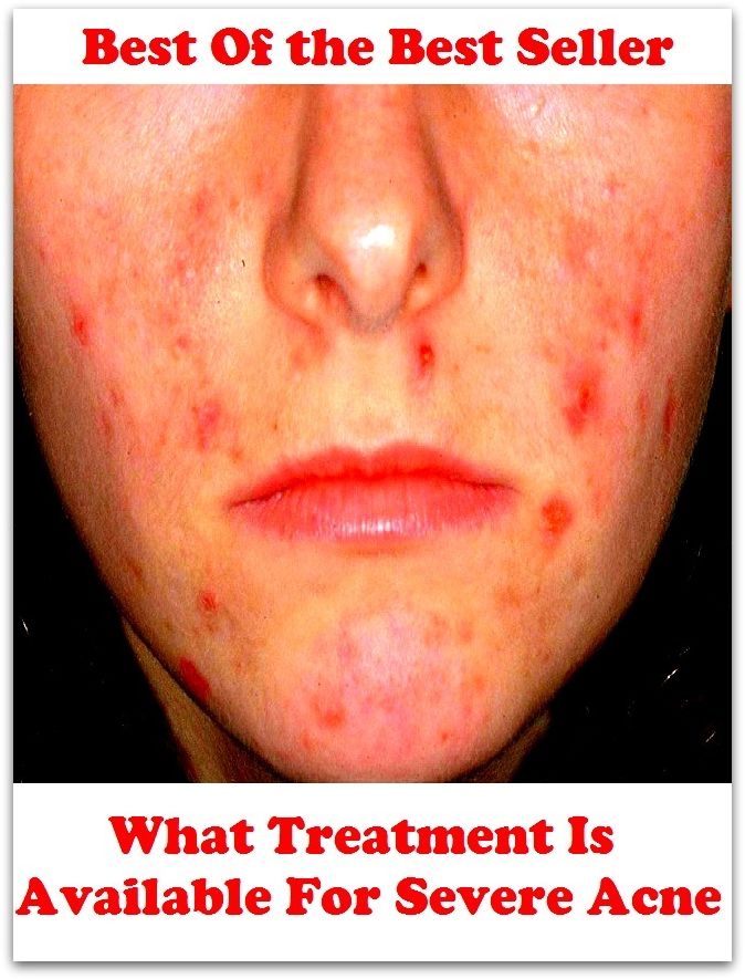 Best of the best sellers What Treatment Is Available For Severe A ( exercise, meditation, acupuncture, disease, digestive system, formula, medicine, remedy, fix, treatment, action, conduct, behavior, handling, gastrin, fitness )