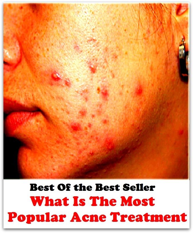 Best of the best sellers What Is The Most Popular Acne Treatment ( exercise, meditation, acupuncture, disease, digestive system, formula, medicine, remedy, fix, treatment, action, conduct, behavior, handling, gastrin, fitness, vitamins )