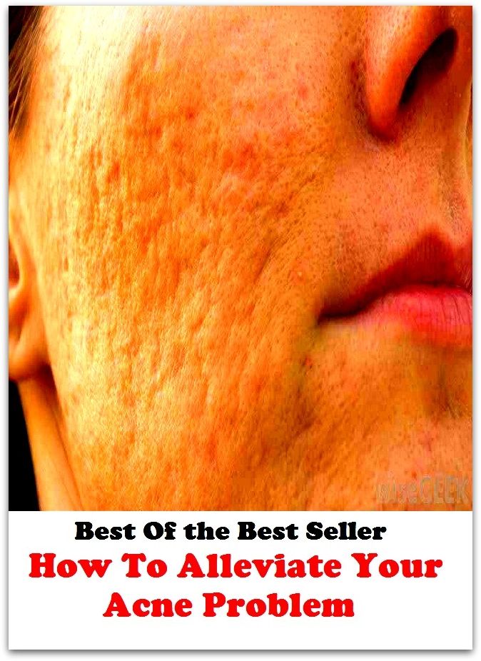Best of the best sellers How To Alleviate Your Acne Problem ( exercise, meditation, acupuncture, disease, digestive system, formula, medicine, remedy, fix, treatment, action, conduct, behavior, handling, gastrin, fitness, vitamins )