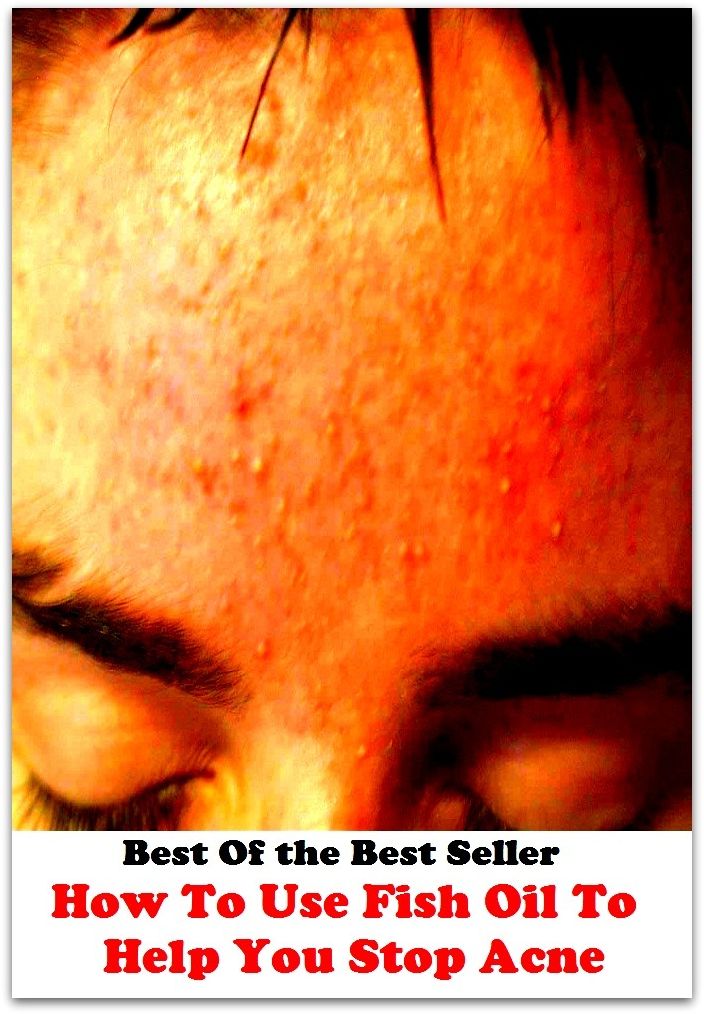 Best of the best sellers How To Use Fish Oil To Help You Stop Acn ( exercise, meditation, acupuncture, disease, digestive system, formula, medicine, remedy, fix, treatment, action, conduct, behavior, handling, gastrin, fitness )