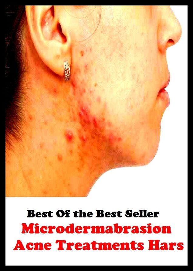 Best of the best sellers Microdermabrasion Acne Treatments Hars ( exercise, meditation, acupuncture, disease, digestive system, formula, medicine, remedy, fix, treatment, action, conduct, behavior, handling, gastrin, fitness, vitamins )