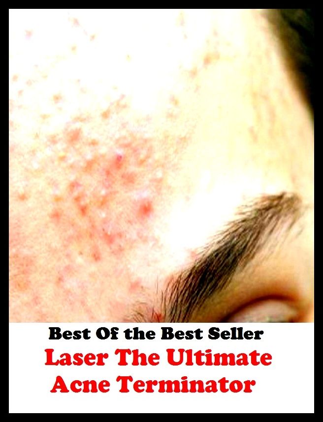 Best of the best sellers Laser The Ultimate Acne Terminator ( exercise, meditation, acupuncture, disease, digestive system, formula, medicine, remedy, fix, treatment, action, conduct, behavior, handling, gastrin, fitness, vitamins )
