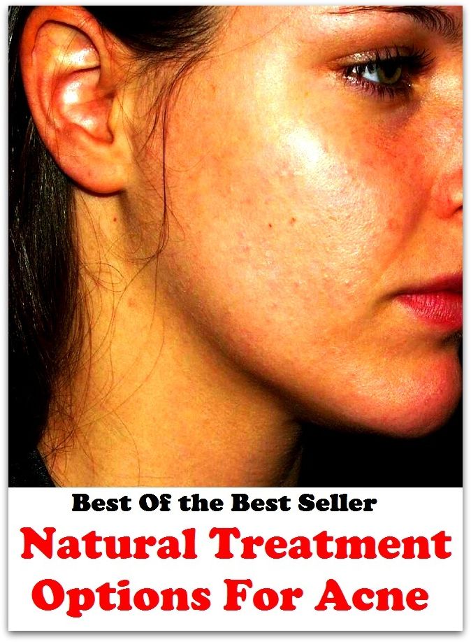 Best of the best sellers Natural Treatment Options For Acne ( exercise, meditation, acupuncture, disease, digestive system, formula, medicine, remedy, fix, treatment, action, conduct, behavior, handling, gastrin, fitness, vitamins )