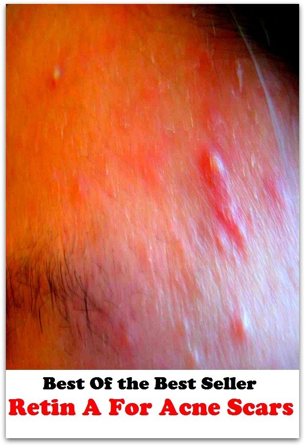 Best of the best sellers Retin A For Acne Scars ( exercise, meditation, acupuncture, disease, digestive system, formula, medicine, remedy, fix, treatment, action, conduct, behavior, handling, gastrin, fitness, vitamins, healing, diet )