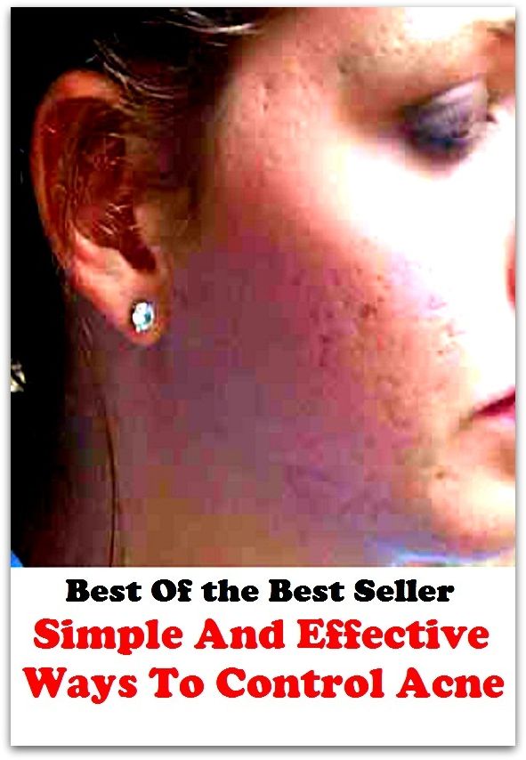 Best of the best sellers Simple And Effective Ways To Control Acn ( exercise, meditation, acupuncture, disease, digestive system, formula, medicine, remedy, fix, treatment, action, conduct, behavior, handling, gastrin, fitness )