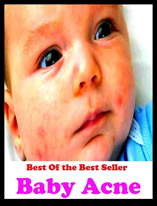 Best of the best sellers Baby Acne ( exercise, meditation, acupuncture, disease, digestive system, formula, medicine, remedy, fix, treatment, action, conduct, behavior, handling, gastrin, fitness, vitamins, healing, diet, cut down )