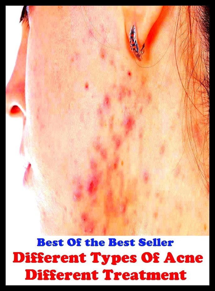 Best of the best sellers Different Types Of Acne Different Treat ( exercise, meditation, acupuncture, disease, digestive system, formula, medicine, remedy, fix, treatment, action, conduct, behavior, handling, gastrin, fitness, vitamins )