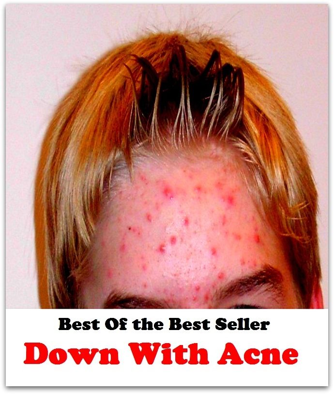 Best of the best sellers Down With Acne ( exercise, meditation, acupuncture, disease, digestive system, formula, medicine, remedy, fix, treatment, action, conduct, behavior, handling, gastrin, fitness, vitamins, healing, diet, cut down )