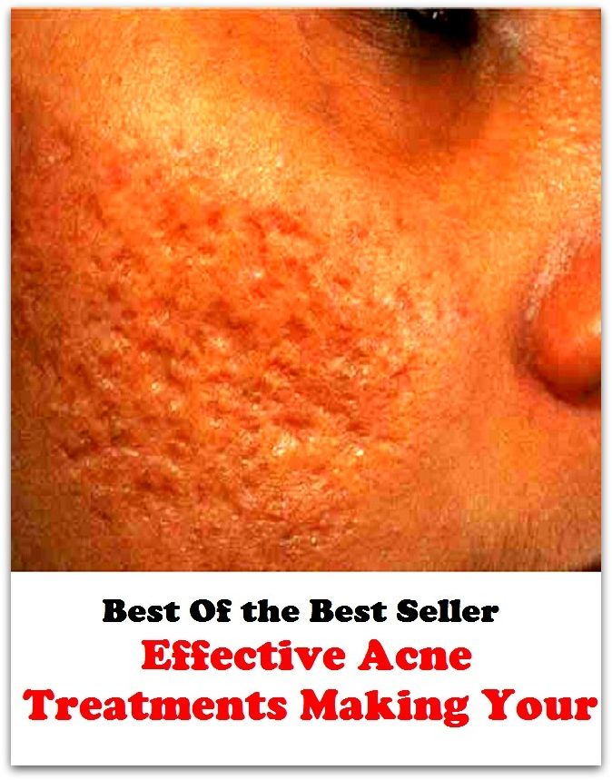 Best of the best sellers Effective Acne Treatments Making Your ( exercise, meditation, acupuncture, disease, digestive system, formula, medicine, remedy, fix, treatment, action, conduct, behavior, handling, gastrin, fitness, vitamins )