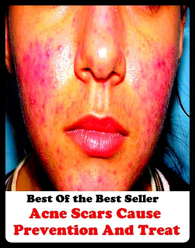 Best of the best sellers Acne Scars Cause Prevention And Treat ( exercise, meditation, acupuncture, disease, digestive system, formula, medicine, remedy, fix, treatment, action, conduct, behavior, handling, gastrin, fitness, vitamins )