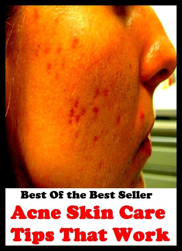 Best of the best sellers Acne Skin Care Tips That Work ( exercise, meditation, acupuncture, disease, digestive system, formula, medicine, remedy, fix, treatment, action, conduct, behavior, handling, gastrin, fitness, vitamins, healing )