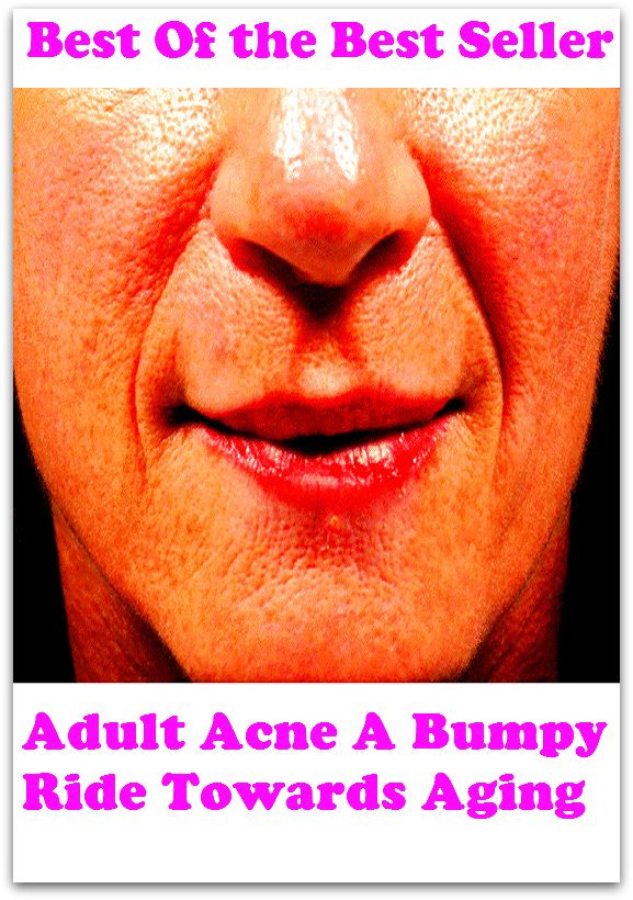 Best of the best sellers Adult Acne A Bumpy Ride Towards Aging ( exercise, meditation, acupuncture, disease, digestive system, formula, medicine, remedy, fix, treatment, action, conduct, behavior, handling, gastrin, fitness, vitamins )