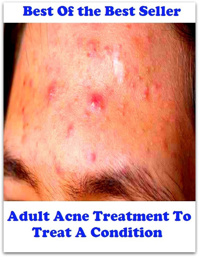 Best of the best sellers Adult Acne Treatment To Treat A Condit ( exercise, meditation, acupuncture, disease, digestive system, formula, medicine, remedy, fix, treatment, action, conduct, behavior, handling, gastrin, fitness, vitamins )