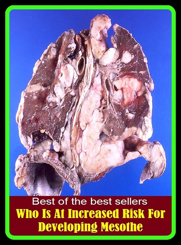 Best of the Best Sellers Who Is At Increased Risk For Developing Mesothe (at gunpoint, at half mast, at hand, at heart, at home, at intervals, at issue, at knife point, at large, at last)