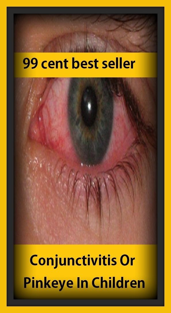 99 cent best seller Conjunctivitis Or Pinkeye In Children ( conjunctive normal form, conjunctive, conjunctives, conjunctivitis, conjunctivitis arid, conjunctivitis, acute hemorrhagic, conjunctivitis, allergic, conjunctivitis, bacterial, conjunctive)