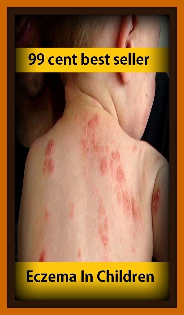 99 cent best seller Eczema In Children ( cw, cycle, eczema, eczema hermetic, eczema hypertrophy, eczema marginality, eczema vaccination, eczema, hydrostatic, eczema like, eczema tic)