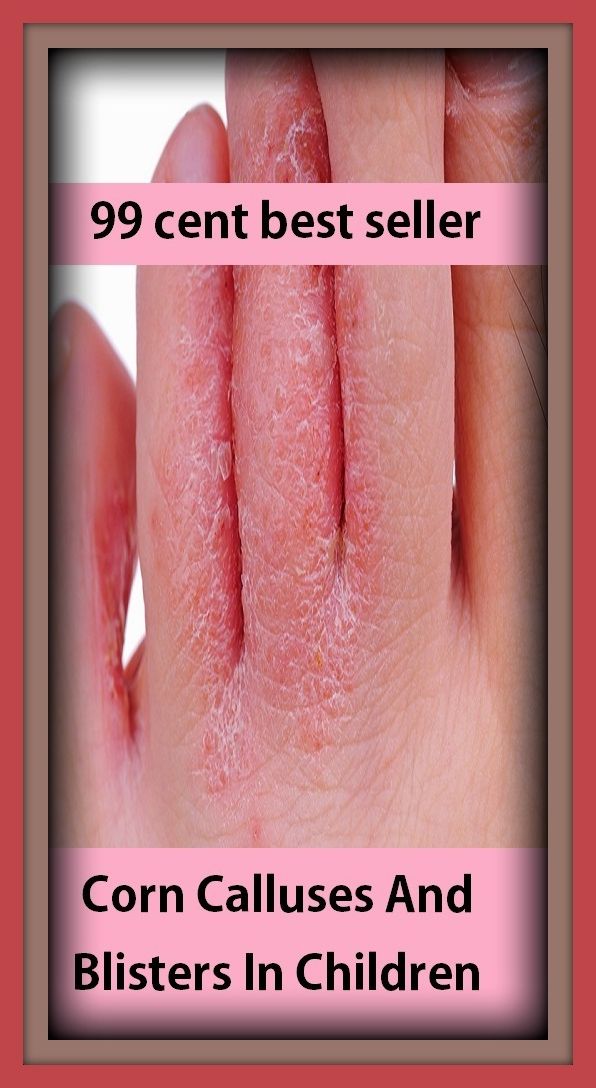 99 cent best seller Corn Calluses And Blisters In Children ( corn borer, corn borer moth, corn bread, corn bunting, corn cake, corn champion, corn chamomile, corn chip, corn chowder, corn cockle)
