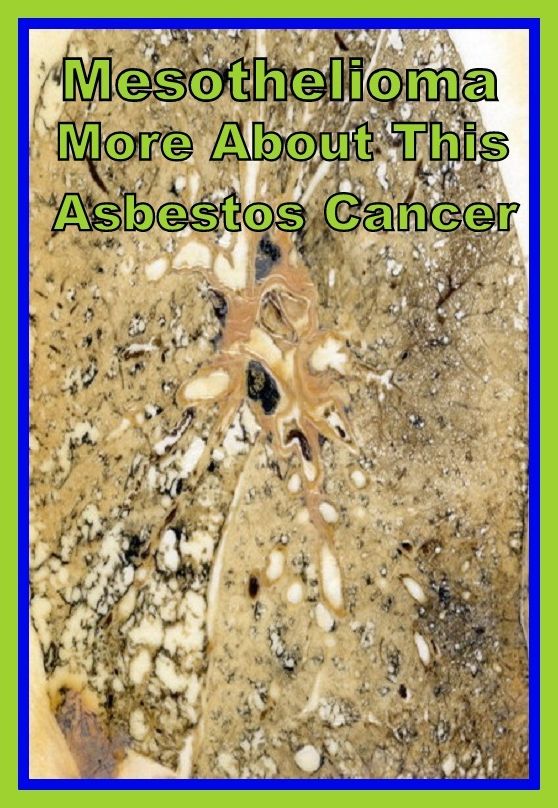 Best of the Sellers Mesothelioma More About This Asbestos Cancer ( exercise, meditation, acupuncture, disease, digestive system, formula, medicine, remedy, fix, treatment, action, conduct, behavior, handling, gastrin, fitness, vitamins, healing, diet )