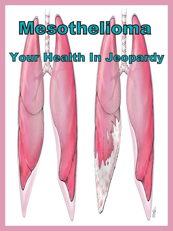Best of the Sellers Mesothelioma Your Health In Jeopardy ( exercise, meditation, acupuncture, disease, digestive system, formula, medicine, remedy, fix, treatment, action, conduct, behavior, handling, gastrin, fitness, vitamins, healing, diet, cut down )