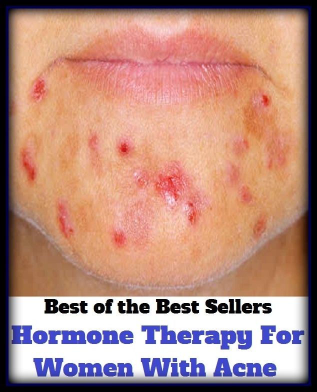 Skincare: Hormone Therapy For Women With Acne (blackheads,pimples,pustules,rosacea,zits, whiteheads, skin inflammation, pizza face, tumor, eruption)