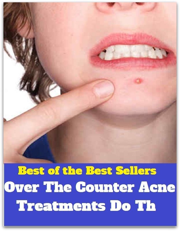 Skincare: Over The Counter Acne Treatments That Do The Trick! (blackheads, pimples, pustules, zits, whiteheads, skin inflammation, pizza face, tumor, eruption)