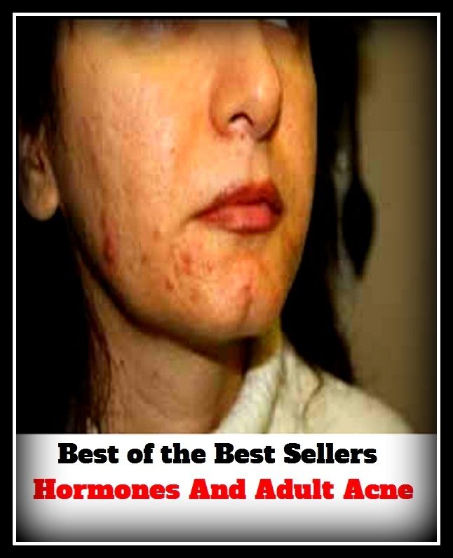 Skincare: Hormones And Adult Acne (blackheads,pimples,pustules, zits, whiteheads, skin inflammation, pizza face, tumor, eruption)