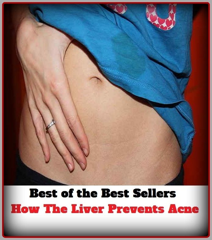 Skincare: How The Liver Prevents Acne (blackheads,pimples,pustules, zits, whiteheads, skin inflammation, pizza face, tumor, eruption)