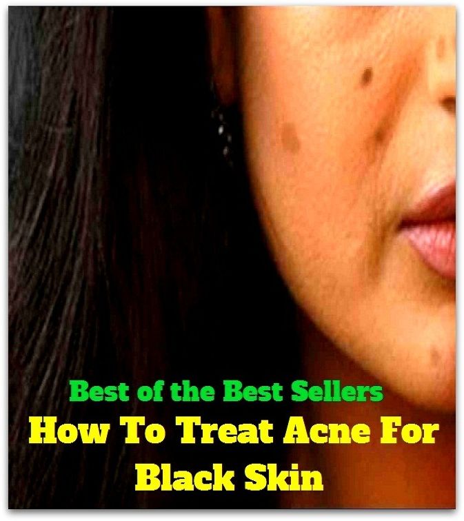 Best of the Best Sellers How To Treat Acne For Black Skin(blackheads,pimples,pustules,rosacea,zits, whiteheads, skin inflammation, pizza face, tumor, eruption)