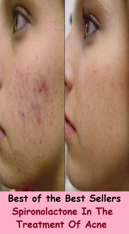 Best of the Best Sellers Spironolactone In The Treatment Of Acne (behavior,dealing,analysis, hospitalization, regiment, surgery,therapy, medication, prescription, operation)