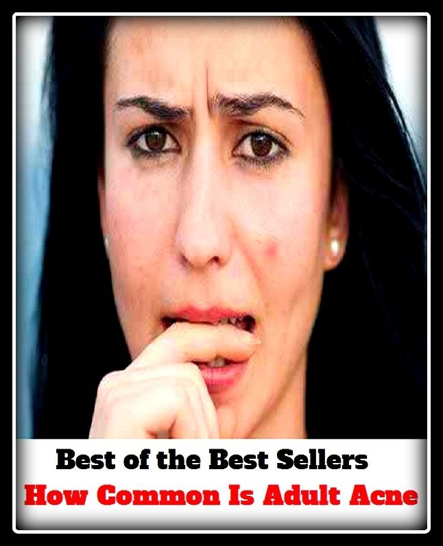 Best of the Best Sellers How Common Is Adult Acne (blackheads,pimples,pustules,rosacea,zits, whiteheads, skin inflammation, pizza face, tumor, eruption)