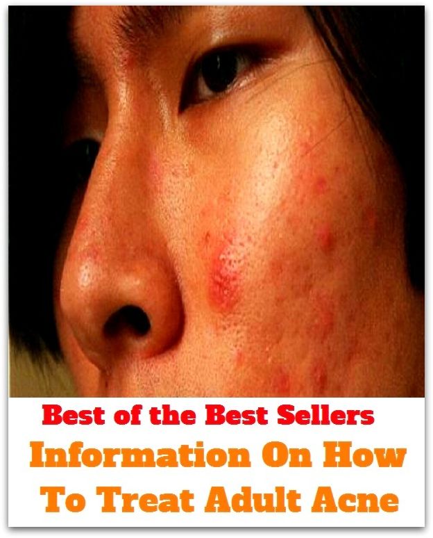 Skincare: Information On How To Treat Adult Acne (blackheads, pimples, pustules, zits, whiteheads, skin inflammation, pizza face, tumor, eruption)