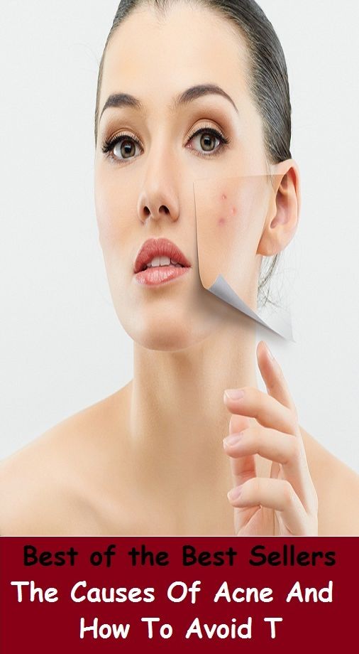Best of the Best Sellers The Causes Of Acne And How To Avoid (blackheads,pimples,pustules,rosacea,zits, whiteheads, skin inflammation, pizza face, tumor, eruption)