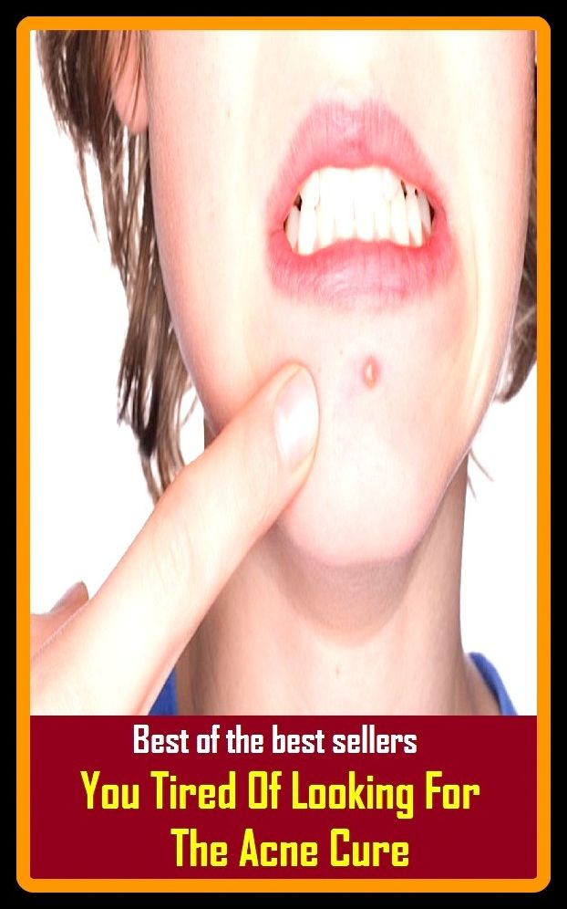 Best of the Best Sellers Are You Tired Of Looking For The Acne Cure ( acme ism, atheistic, acme lease, acne, acne festivals, acne celluloid, acne Cesaro, acne vulgarism, caned, cuneiform)