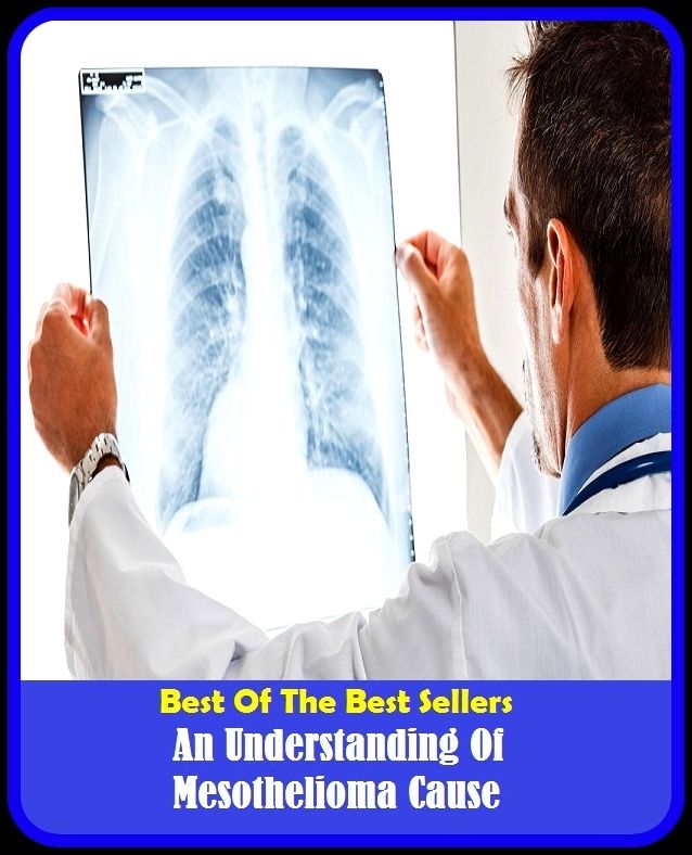 Best of the Best Sellers An Understanding Of Mesothelioma Cause ( structured, tartaric, mesothelioma, mesothelioma, mesothelioma, mesothelioma, cystic, mesothelioma, chemotherapy, thoracic, mesothelioma )