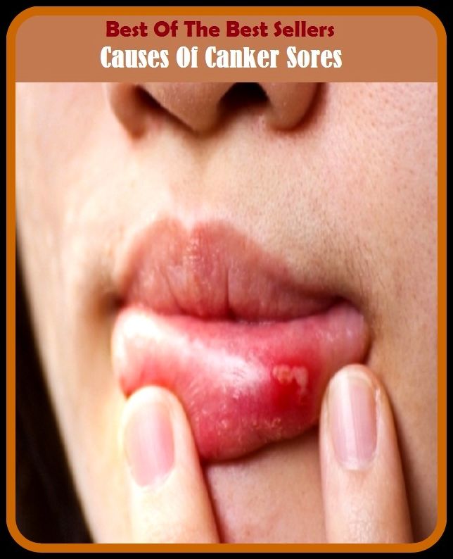 Best of the Best Sellers Causes Of Canker Sores ( canker blossom, canker brake, canker fly, canker rash, canker sore, canker-bit, cankered, concertedly, contentedness, cankering )