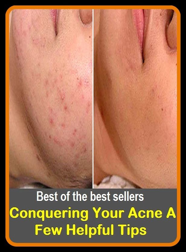 Acne Treatment: Best Sellers Conquering Your Acne A Few Helpful Tips