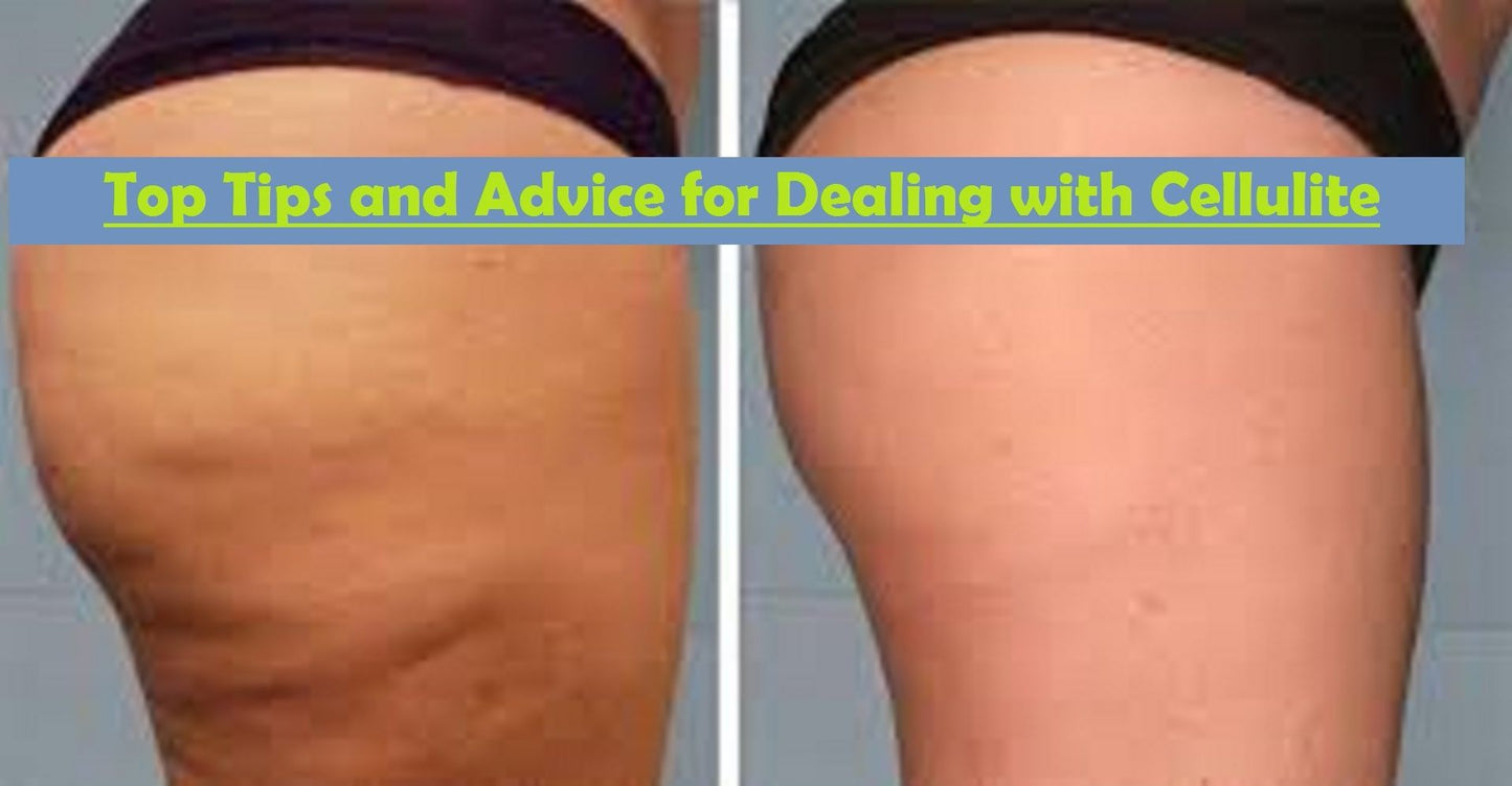 Top Tips and Advice for Dealing with Cellulite