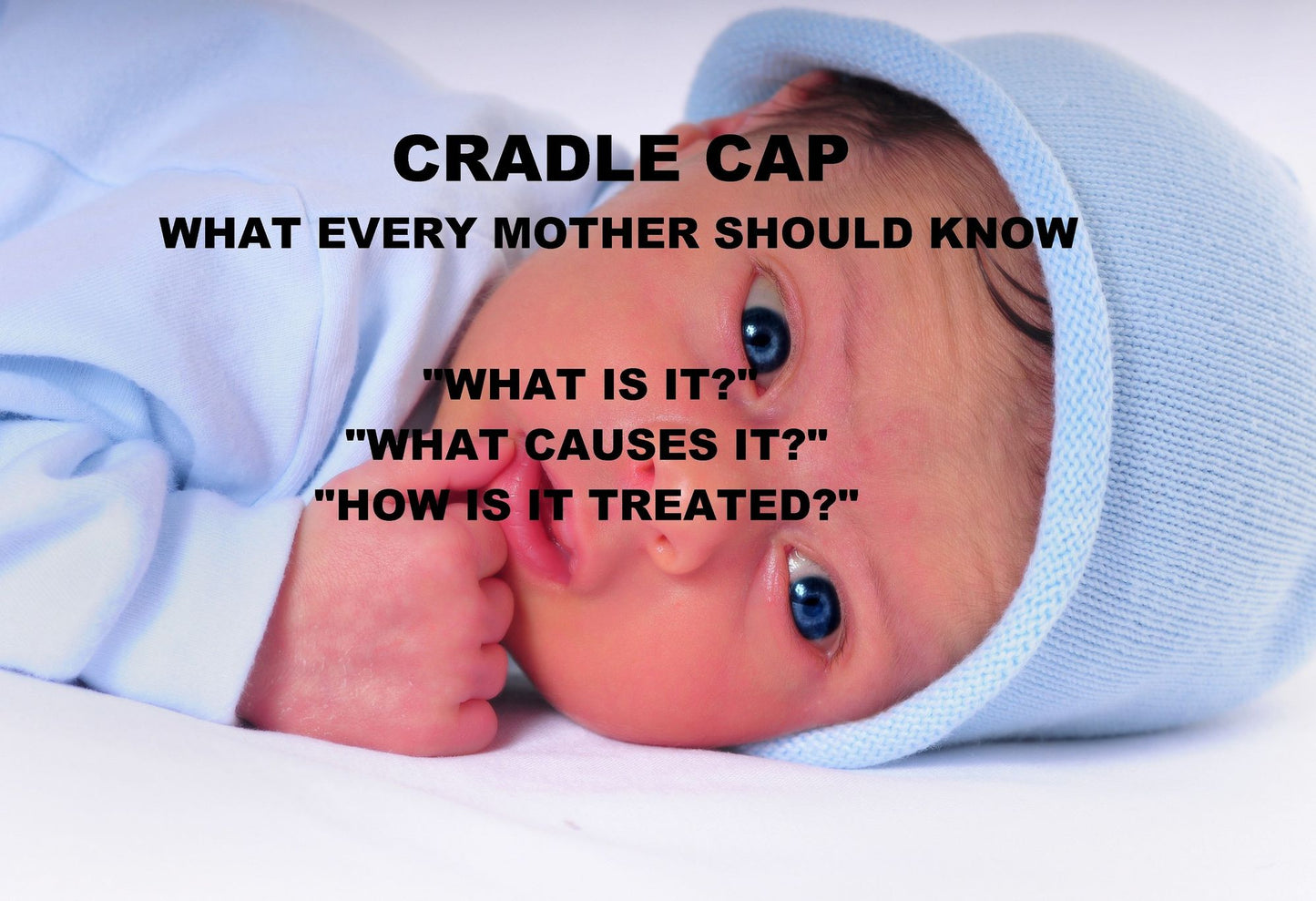 Cradle Cap