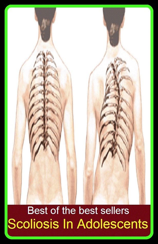 Best of the Best Sellers Scoliosis In Adolescents (juvenile, teenager, youth, teen, minor, youngster, stripling, sweet sixteen)