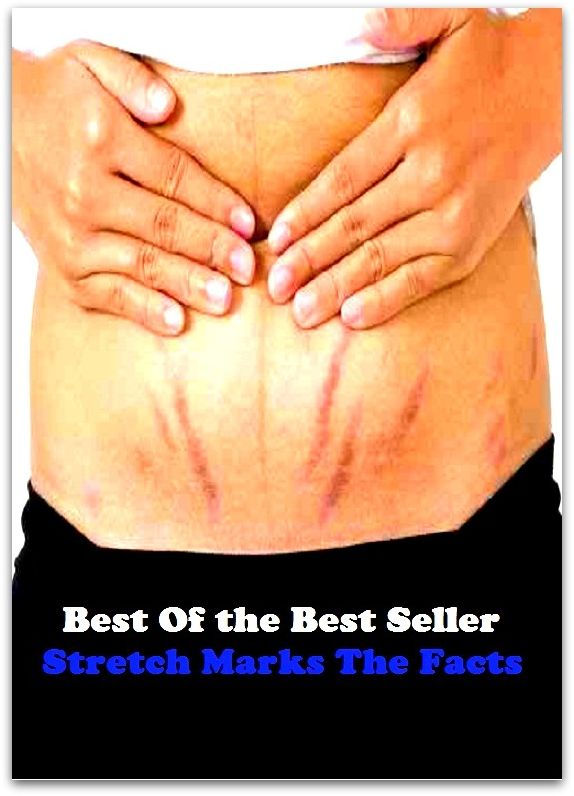Best of the best sellers Stretch Marks The Facts ( exercise, meditation, acupuncture, disease, digestive system, formula, medicine, remedy, fix, treatment, action, conduct, behavior, handling, gastrin, fitness, vitamins, healing, diet )
