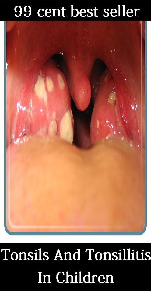 99 cent best seller Tonsils And Tonsillitis In Children (tonsillitis, tonsillectomy, tonsillectomy, tonsillectomy, tonsils, tensor, tonsorial, tonsure, tonsured, ton tine)